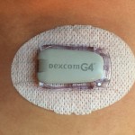 Dexcom Sensor Setup